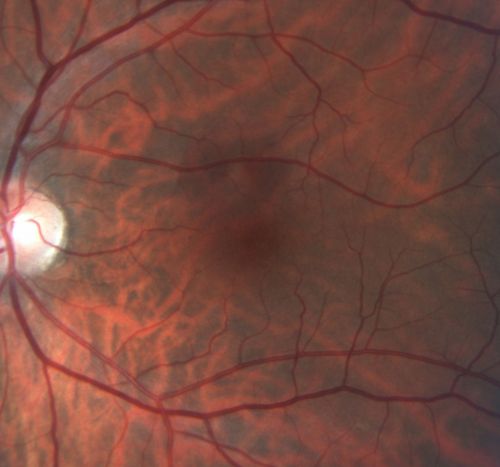 Occult Maculopathy - Thin Fovea on OCT and Normal Color VA, Photos, FA VA 20/80 OU
45-year-old man his mother and his maternal grandmother each had vision loss at a relatively young age.  Macula OS looks normal
Keywords: occult maculopathy;foveal atrophy