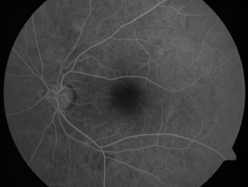 Occult Maculopathy - Thin Fovea on OCT and Normal Color VA, Photos, FA VA 20/80 OU
45-year-old man  The FA is entirely normal.

Keywords: occult maculopathy;foveal atrophy