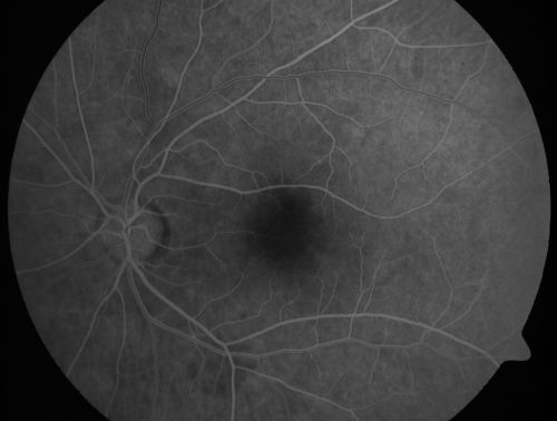 Occult Maculopathy - Thin Fovea on OCT and Normal Color VA, Photos, FA VA 20/80 OU
45-year-old man   The FA is entirely normal.

Keywords: occult maculopathy;foveal atrophy