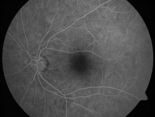 Occult Maculopathy - Thin Fovea on OCT and Normal Color VA, Photos, FA VA 20/80 OU
45-year-old man Normal FA
Keywords: occult maculopathy;foveal atrophy
