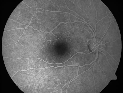 Occult Maculopathy - Thin Fovea on OCT and Normal Color VA, Photos, FA VA 20/80 OU
45-year-old man Normal FA
Keywords: occult maculopathy;foveal atrophy