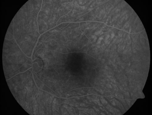 Occult Maculopathy - Thin Fovea on OCT and Normal Color VA, Photos, FA VA 20/80 OU
45-year-old man Normal FA
Keywords: occult maculopathy;foveal atrophy