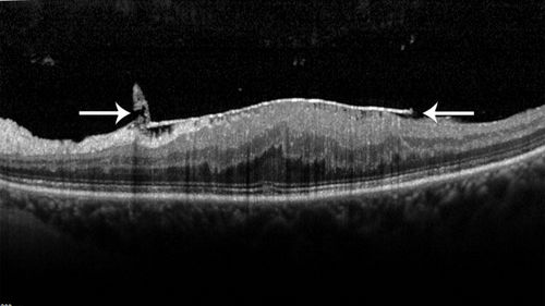 Vitrectomy with membrane peel
Intraoperative images showing the peeling of an epiretinal membrane - macular pucker - with a 25 gauge forcepts.
