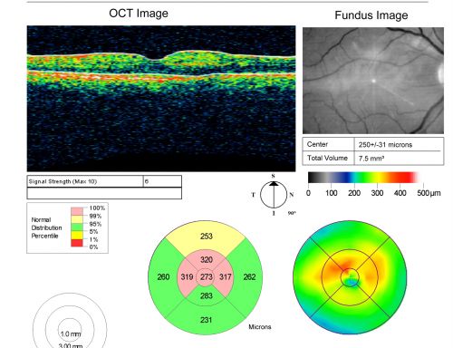 Branch Retinal Arterial Occlusion 20/20 Vision - Symptoms for 1 Day
75-year-old man was seen in the office on 4/6/2010.  He noticed a sudden vision change in the right eye yesterday morning.  20/20 Vision both Eyes

