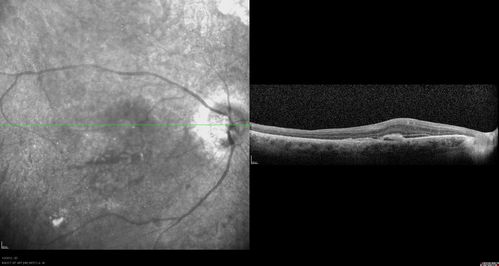 Post-Retinal Detachment Repair Occult Subfoveal CNVM
This pleasant 56-year-old man has had a complex retinal detachment repair in the right eye.  I most recently removed his silicone oil 3 months ago.  His vision now is the best it has ever been. 
VISUAL ACUITY:  OD 4/200
