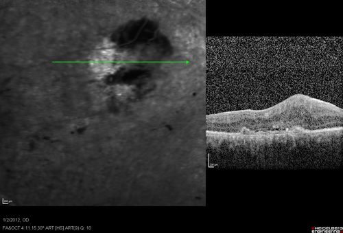 Post-Retinal Detachment Repair Occult Subfoveal CNVM
This pleasant 56-year-old man has had a complex retinal detachment repair in the right eye.  I most recently removed his silicone oil 3 months ago.  His vision now is the best it has ever been. 
VISUAL ACUITY:  OD 4/200
