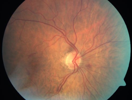 Microaneurysms from Ocular Ischemic Syndrome (non-diabetic) Right Eye - Left eye CRAO 1 year ago
66-year-old woman lost vision in the left eye from a central retinal artery occlusion 1 year ago.  Vision OD is fine.  OD 20/25,  OS 20/50

