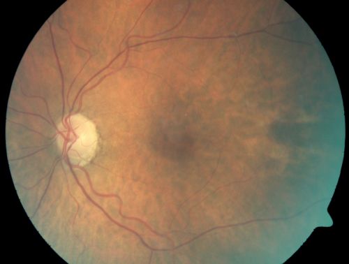 Microaneurysms from Ocular Ischemic Syndrome (non-diabetic) Right Eye - Left eye CRAO 1 year ago
66-year-old woman lost vision in the left eye from a central retinal artery occlusion 1 year ago.  Vision OD is fine.  OD 20/25,  OS 20/50
