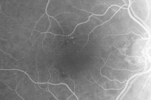 Microaneurysms from Ocular Ischemic Syndrome (non-diabetic) Right Eye - Left eye CRAO 1 year ago
66-year-old woman lost vision in the left eye from a central retinal artery occlusion 1 year ago.  Vision OD is fine.  OD 20/25,  OS 20/50
