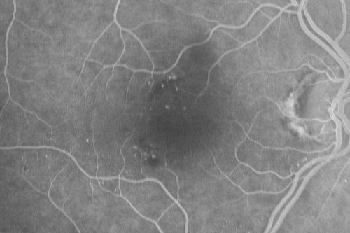 Microaneurysms from Ocular Ischemic Syndrome (non-diabetic) Right Eye - Left eye CRAO 1 year ago
66-year-old woman lost vision in the left eye from a central retinal artery occlusion 1 year ago.  Vision OD is fine.  OD 20/25,  OS 20/50
