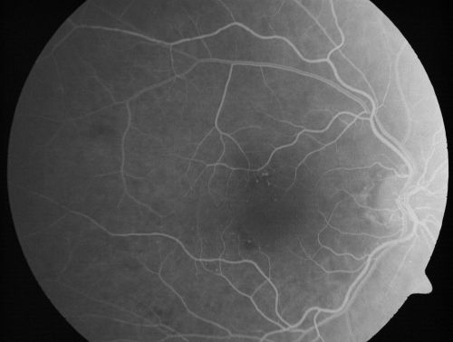 Microaneurysms from Ocular Ischemic Syndrome (non-diabetic) Right Eye - Left eye CRAO 1 year ago
66-year-old woman lost vision in the left eye from a central retinal artery occlusion 1 year ago.  Vision OD is fine.  OD 20/25,  OS 20/50
