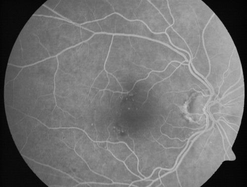 Microaneurysms from Ocular Ischemic Syndrome (non-diabetic) Right Eye - Left eye CRAO 1 year ago
66-year-old woman lost vision in the left eye from a central retinal artery occlusion 1 year ago.  Vision OD is fine.  OD 20/25,  OS 20/50
