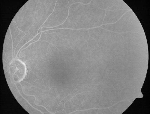 Microaneurysms from Ocular Ischemic Syndrome (non-diabetic) Right Eye - Left eye CRAO 1 year ago
66-year-old woman lost vision in the left eye from a central retinal artery occlusion 1 year ago.  Vision OD is fine.  OD 20/25,  OS 20/50
