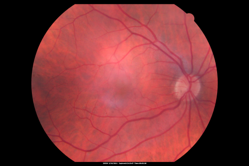 Ocular Ishemic Syndrome - Bilateral Carotid Occlusions - OD 20/60 OS 20/200 Enlarged Foveal Avascular Zone and Temporal Non-perfusion
75-year-old man had laryngeal cancer treated in 15 year ago with radiation.  He recently was told that the carotid circulation is closed off on both sides.  He does have a patent vertebral artery, which is supplying him pretty well and in addition to that his cardiac output is compromised by poor mitral valves.  His consideration is to what can be done about that in the future.  
VISUAL ACUITY:  OD 20/60,  OS 20/200
