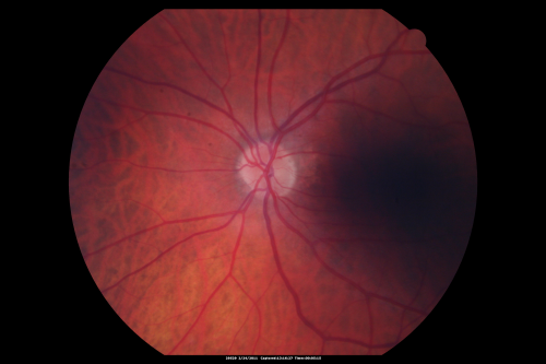 Ocular Ishemic Syndrome - Bilateral Carotid Occlusions - OD 20/60 OS 20/200 Enlarged Foveal Avascular Zone and Temporal Non-perfusion
75-year-old man had laryngeal cancer treated in 15 year ago with radiation.  He recently was told that the carotid circulation is closed off on both sides.  He does have a patent vertebral artery, which is supplying him pretty well and in addition to that his cardiac output is compromised by poor mitral valves.  His consideration is to what can be done about that in the future.  
VISUAL ACUITY:  OD 20/60,  OS 20/200
