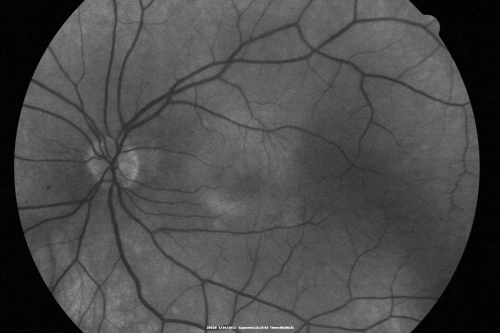 Ocular Ishemic Syndrome - Bilateral Carotid Occlusions - OD 20/60 OS 20/200 Enlarged Foveal Avascular Zone and Temporal Non-perfusion
75-year-old man had laryngeal cancer treated in 15 year ago with radiation.  He recently was told that the carotid circulation is closed off on both sides.  He does have a patent vertebral artery, which is supplying him pretty well and in addition to that his cardiac output is compromised by poor mitral valves.  His consideration is to what can be done about that in the future.  
VISUAL ACUITY:  OD 20/60,  OS 20/200
