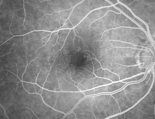 Ocular Ishemic Syndrome - Bilateral Carotid Occlusions - OD 20/60 OS 20/200 Enlarged Foveal Avascular Zone and Temporal Non-perfusion
75-year-old man had laryngeal cancer treated in 15 year ago with radiation.  He recently was told that the carotid circulation is closed off on both sides.  He does have a patent vertebral artery, which is supplying him pretty well and in addition to that his cardiac output is compromised by poor mitral valves.  His consideration is to what can be done about that in the future.  
VISUAL ACUITY:  OD 20/60,  OS 20/200
