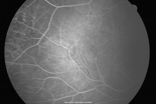 Ocular Ishemic Syndrome - Bilateral Carotid Occlusions - OD 20/60 OS 20/200 Enlarged Foveal Avascular Zone and Temporal Non-perfusion
75-year-old man had laryngeal cancer treated in 15 year ago with radiation.  He recently was told that the carotid circulation is closed off on both sides.  He does have a patent vertebral artery, which is supplying him pretty well and in addition to that his cardiac output is compromised by poor mitral valves.  His consideration is to what can be done about that in the future.  
VISUAL ACUITY:  OD 20/60,  OS 20/200

