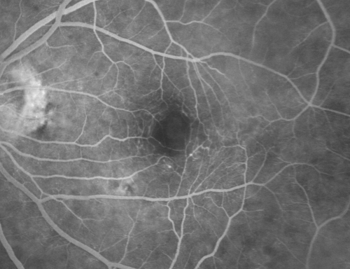 Ocular Ishemic Syndrome - Bilateral Carotid Occlusions - OD 20/60 OS 20/200 Enlarged Foveal Avascular Zone and Temporal Non-perfusion
75-year-old man had laryngeal cancer treated in 15 year ago with radiation.  He recently was told that the carotid circulation is closed off on both sides.  He does have a patent vertebral artery, which is supplying him pretty well and in addition to that his cardiac output is compromised by poor mitral valves.  His consideration is to what can be done about that in the future.  
VISUAL ACUITY:  OD 20/60,  OS 20/200
