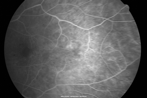 Ocular Ishemic Syndrome - Bilateral Carotid Occlusions - OD 20/60 OS 20/200 Enlarged Foveal Avascular Zone and Temporal Non-perfusion
75-year-old man had laryngeal cancer treated in 15 year ago with radiation.  He recently was told that the carotid circulation is closed off on both sides.  He does have a patent vertebral artery, which is supplying him pretty well and in addition to that his cardiac output is compromised by poor mitral valves.  His consideration is to what can be done about that in the future.  
VISUAL ACUITY:  OD 20/60,  OS 20/200

