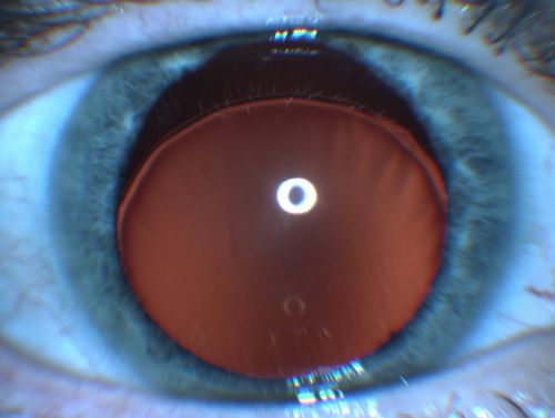 Ectopia Lentis - Marfan's Syndrome - Intermittent Pupillary Block Glaucoma Right Eye
41-year-old woman decreased vision right eye and intermittent pupillary block glaucoma for 6 months from a dislocated natural lens in the eye, probably associated with Marfan syndrome.Vision OD is 20/160, PH 20/40; OS is 20/30, PH 20/25
