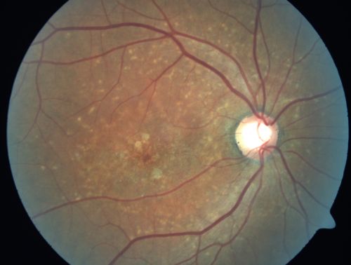 Stargardt's Juvenille Macular Dystrophy - Fundus Flavimaculatus - Famlial
55-year-old woman was seen in the office on 11/18/08.  She has a half sister with Stargardtâ€™s disease and seven other siblings who are fine.  20/120 OD, 20/160 OS.
