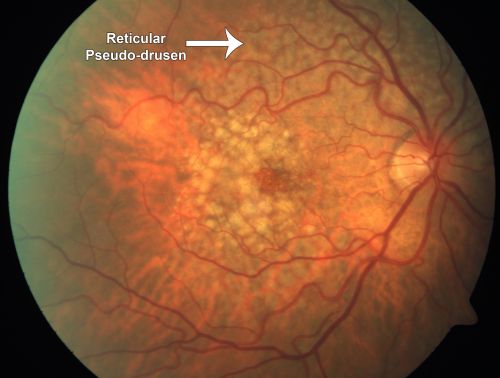 Reticular Macular Disease - Reticular Pseudodrusen and Soft Macular Drusen - 57 Year Old Woman
57-year-old woman was seen in the office on 2/22/2011.  She has macular drusen in both eyes.  I saw her back in 2006.  Since then she does notice slight increased distortion.  OD is 20/25, OS is 20/25
