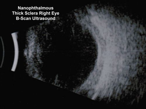 Nanopthalmous (Microphthalmous) Chorioretinal Folds and Choroidal Thickening Both Eyes B-Scan Ultrasound
