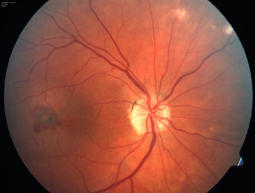 Presumed Ocular Histoplasmosis with new CNVM in right and better eye - VA 20/80 OD; 20/800 OS
Peripheral punched out small scars typical for OHS
