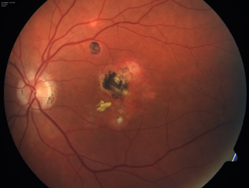 Presumed Ocular Histoplasmosis with new CNVM in right and better eye - VA 20/80 OD; 20/800 OS
Macular scar 20 years old
