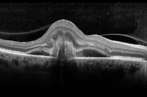 Presumed Ocular Histoplasmosis with new CNVM in right and better eye - VA 20/80 OD; 20/800 OS
