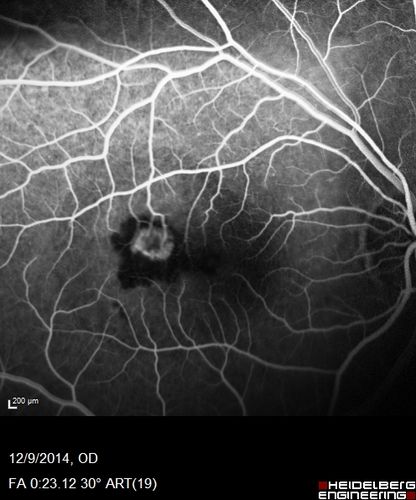 Presumed Ocular Histoplasmosis with new CNVM in right and better eye - VA 20/80 OD; 20/800 OS
Fluorescein Angiogram
