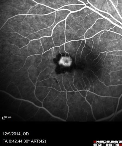 Presumed Ocular Histoplasmosis with new CNVM in right and better eye - VA 20/80 OD; 20/800 OS
Fluorescein Angiogram
