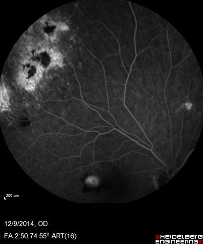 Presumed Ocular Histoplasmosis with new CNVM in right and better eye - VA 20/80 OD; 20/800 OS
Fluorescein Angiogram
