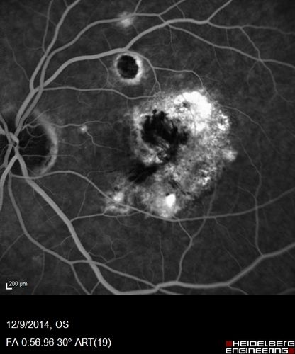 Presumed Ocular Histoplasmosis with new CNVM in right and better eye - VA 20/80 OD; 20/800 OS
Fluorescein Angiogram
