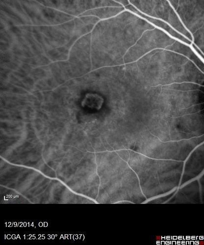 Presumed Ocular Histoplasmosis with new CNVM in right and better eye - VA 20/80 OD; 20/800 OS
Indocyanine Green Angiogram
