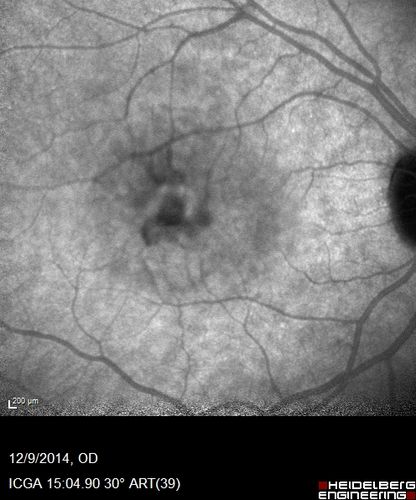 Presumed Ocular Histoplasmosis with new CNVM in right and better eye - VA 20/80 OD; 20/800 OS
Indocyanine Green Angiogram
