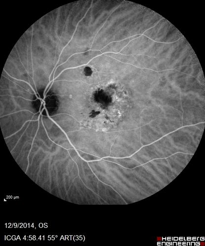 Presumed Ocular Histoplasmosis with new CNVM in right and better eye - VA 20/80 OD; 20/800 OS
Indocyanine Green Angiogram
