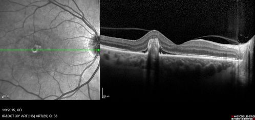 OHS CNVM post treatment with Lucentis - VA now 20/25
