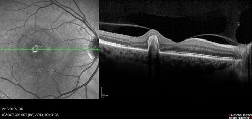 OHS CNVM post treatment with Lucentis - VA now 20/25
