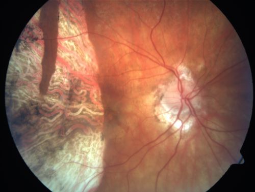 Choriodal Neovascular Membrane - Subfoveal - Pseudo-Retinitis Pigmentosa - 50 years post Retinal Detachment Repair
86-year-old with a history of decreased vision in the right eye.  The patient reports she has lost vision in the right eye over the past two months or so.  She reports the vision was always compromised in that eye since retinal detachment surgery 50 years ago with a scleral buckler. Vision dropped from 20/50 to 20/200 right eye in 2 months.

