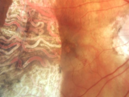 Choriodal Neovascular Membrane - Subfoveal - Pseudo-Retinitis Pigmentosa - 50 years post Retinal Detachment Repair
86-year-old with a history of decreased vision in the right eye.  The patient reports she has lost vision in the right eye over the past two months or so.  She reports the vision was always compromised in that eye since retinal detachment surgery 50 years ago with a scleral buckler. Vision dropped from 20/50 to 20/200 right eye in 2 months.


