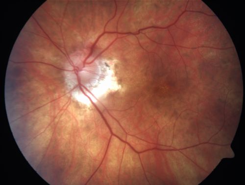 Choriodal Neovascular Membrane - Subfoveal - Pseudo-Retinitis Pigmentosa - 50 years post Retinal Detachment Repair
86-year-old with a history of decreased vision in the right eye.  The patient reports she has lost vision in the right eye over the past two months or so.  She reports the vision was always compromised in that eye since retinal detachment surgery 50 years ago with a scleral buckler. Vision dropped from 20/50 to 20/200 right eye in 2 months.

