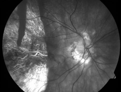 Choriodal Neovascular Membrane - Subfoveal - Pseudo-Retinitis Pigmentosa - 50 years post Retinal Detachment Repair
86-year-old with a history of decreased vision in the right eye.  The patient reports she has lost vision in the right eye over the past two months or so.  She reports the vision was always compromised in that eye since retinal detachment surgery 50 years ago with a scleral buckler. Vision dropped from 20/50 to 20/200 right eye in 2 months.

