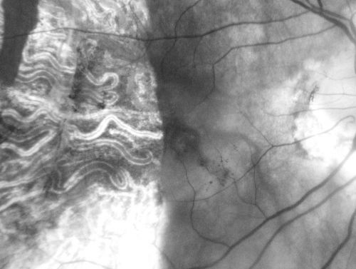 Choriodal Neovascular Membrane - Subfoveal - Pseudo-Retinitis Pigmentosa - 50 years post Retinal Detachment Repair
86-year-old with a history of decreased vision in the right eye.  The patient reports she has lost vision in the right eye over the past two months or so.  She reports the vision was always compromised in that eye since retinal detachment surgery 50 years ago with a scleral buckler. Vision dropped from 20/50 to 20/200 right eye in 2 months.

