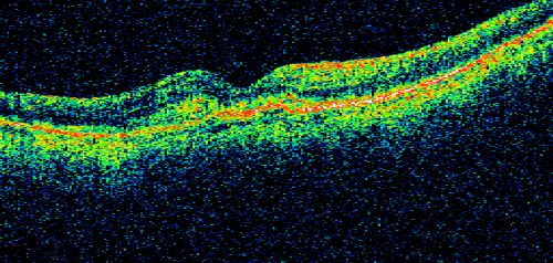 Choriodal Neovascular Membrane - Subfoveal - Pseudo-Retinitis Pigmentosa - 50 years post Retinal Detachment Repair
86-year-old with a history of decreased vision in the right eye.  The patient reports she has lost vision in the right eye over the past two months or so.  She reports the vision was always compromised in that eye since retinal detachment surgery 50 years ago with a scleral buckler. Vision dropped from 20/50 to 20/200 right eye in 2 months.


