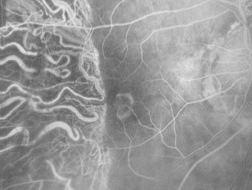 Choriodal Neovascular Membrane - Subfoveal - Pseudo-Retinitis Pigmentosa - 50 years post Retinal Detachment Repair
86-year-old with a history of decreased vision in the right eye.  The patient reports she has lost vision in the right eye over the past two months or so.  She reports the vision was always compromised in that eye since retinal detachment surgery 50 years ago with a scleral buckler. Vision dropped from 20/50 to 20/200 right eye in 2 months.

