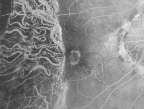 Choriodal Neovascular Membrane - Subfoveal - Pseudo-Retinitis Pigmentosa - 50 years post Retinal Detachment Repair
86-year-old with a history of decreased vision in the right eye.  The patient reports she has lost vision in the right eye over the past two months or so.  She reports the vision was always compromised in that eye since retinal detachment surgery 50 years ago with a scleral buckler. Vision dropped from 20/50 to 20/200 right eye in 2 months.

