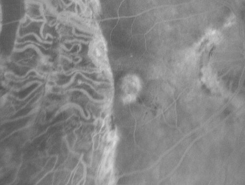 Choriodal Neovascular Membrane - Subfoveal - Pseudo-Retinitis Pigmentosa - 50 years post Retinal Detachment Repair
86-year-old with a history of decreased vision in the right eye.  The patient reports she has lost vision in the right eye over the past two months or so.  She reports the vision was always compromised in that eye since retinal detachment surgery 50 years ago with a scleral buckler. Vision dropped from 20/50 to 20/200 right eye in 2 months.

