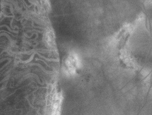 Choriodal Neovascular Membrane - Subfoveal - Pseudo-Retinitis Pigmentosa - 50 years post Retinal Detachment Repair
86-year-old with a history of decreased vision in the right eye.  The patient reports she has lost vision in the right eye over the past two months or so.  She reports the vision was always compromised in that eye since retinal detachment surgery 50 years ago with a scleral buckler. Vision dropped from 20/50 to 20/200 right eye in 2 months.

